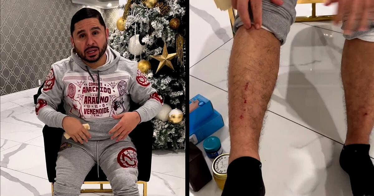 Larry Hernández muestra los golpes que le dejó una aparatosa caída